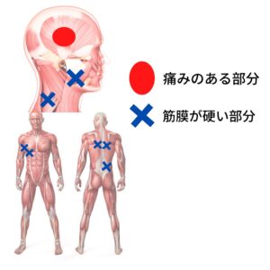 筋膜の図
