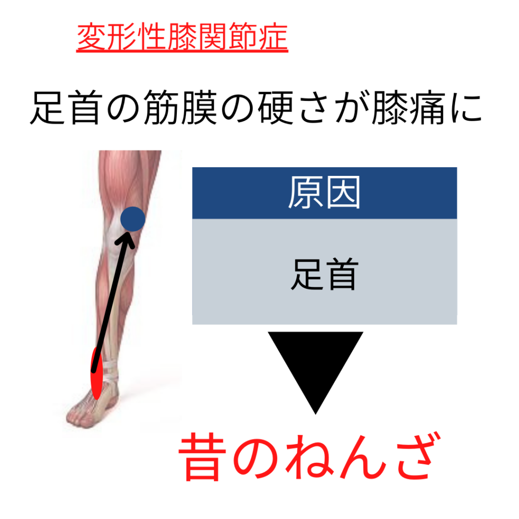 変形性膝関節症|福岡|最新治療