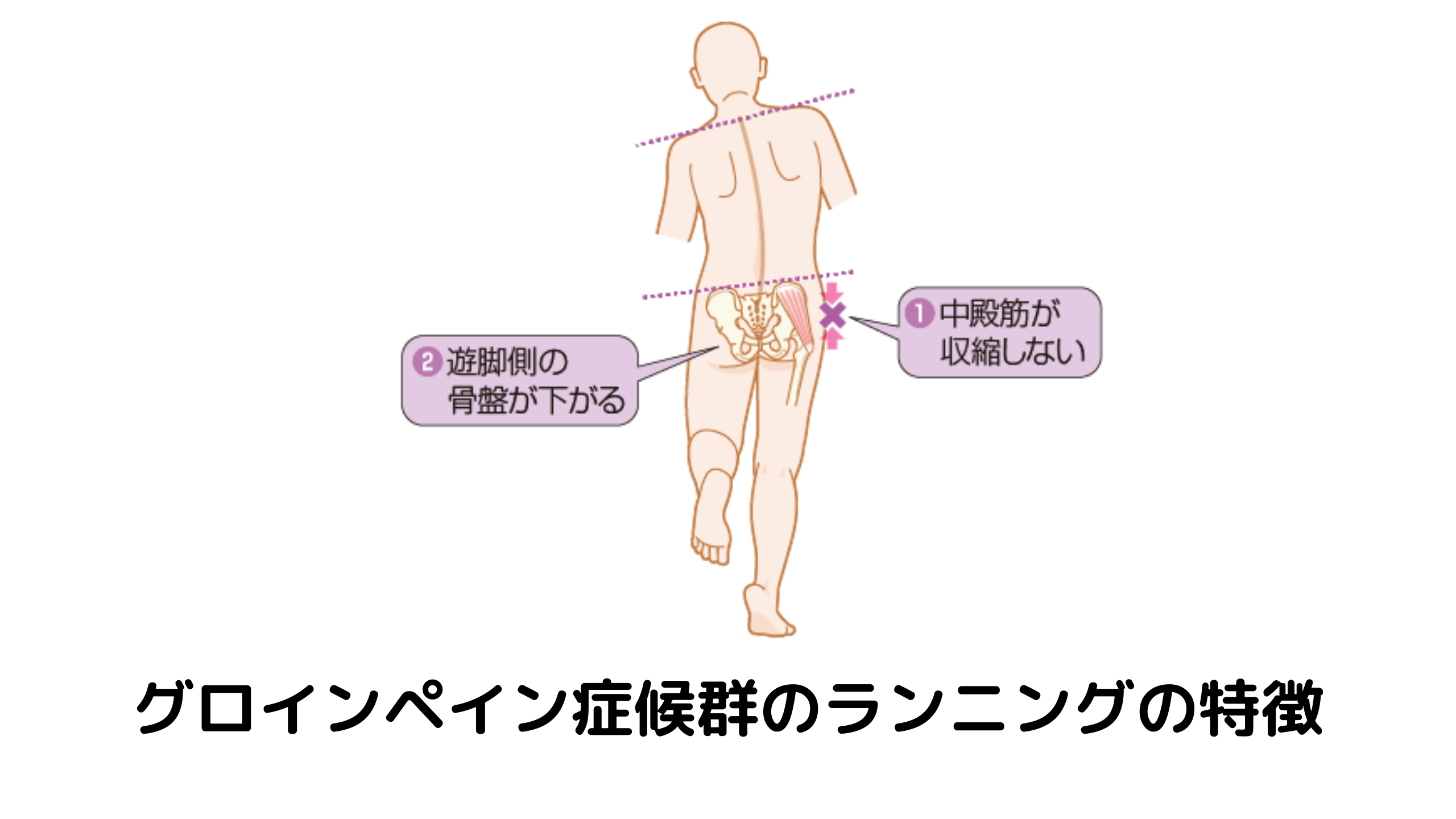 グロインペイン症候群とは