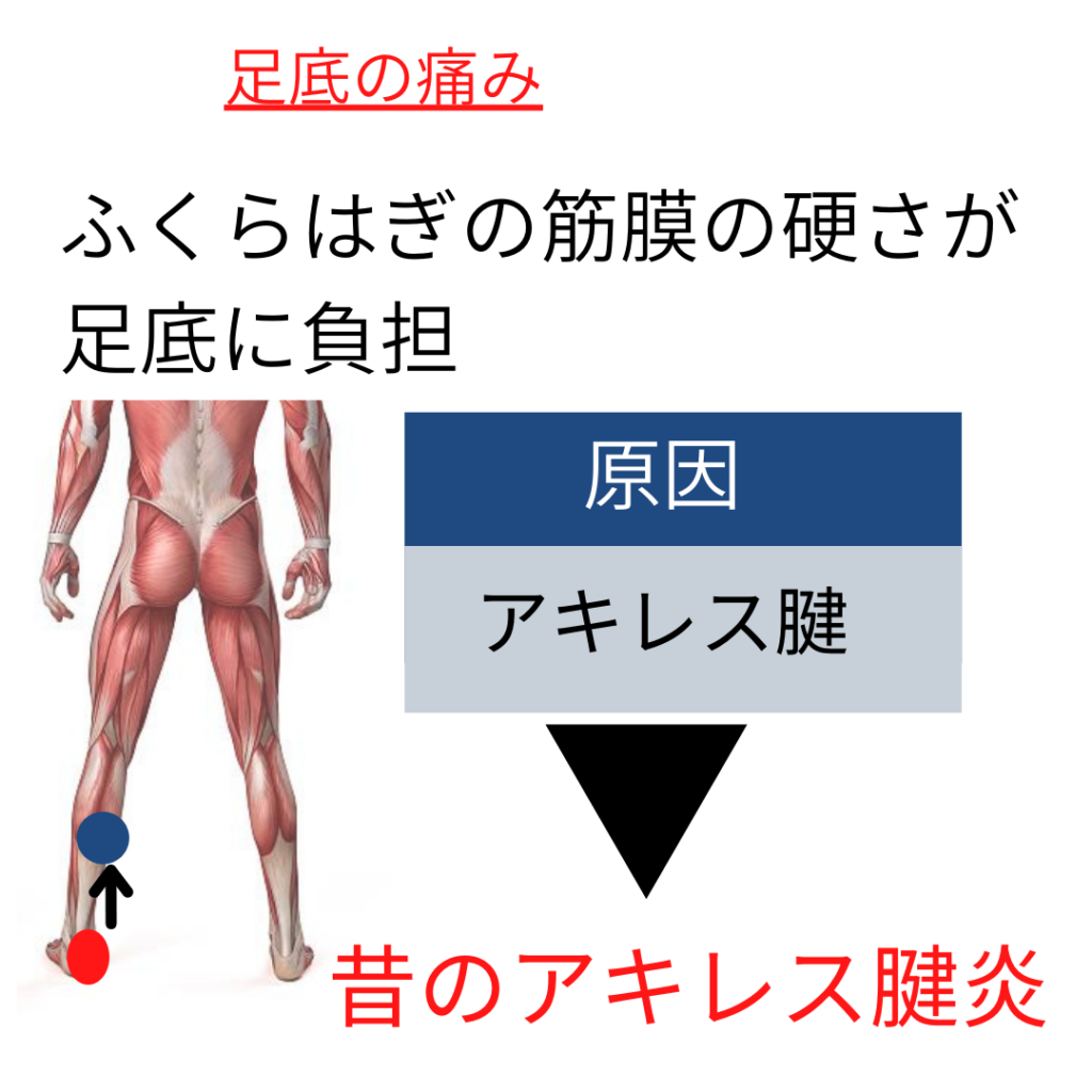 足底筋膜炎、福岡市中央区、治療、筋膜リリース、整体院