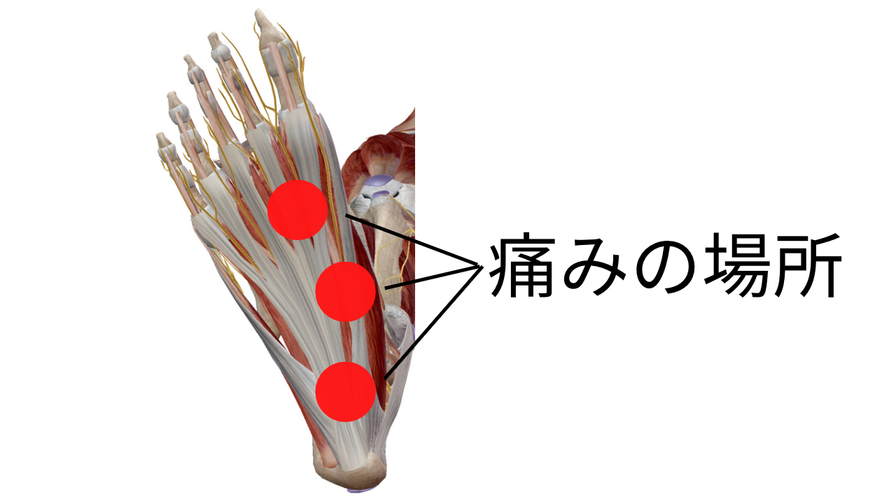 足底筋膜炎、福岡市中央区、治療、筋膜リリース